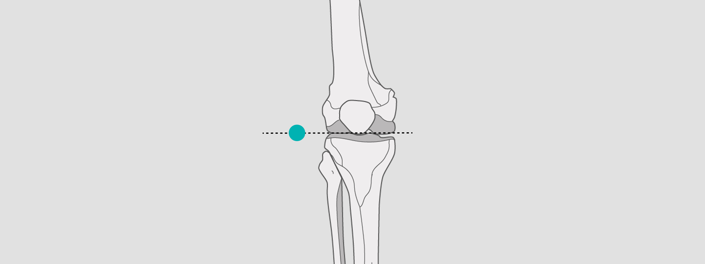 How to do Xray calibration from markers to magnification